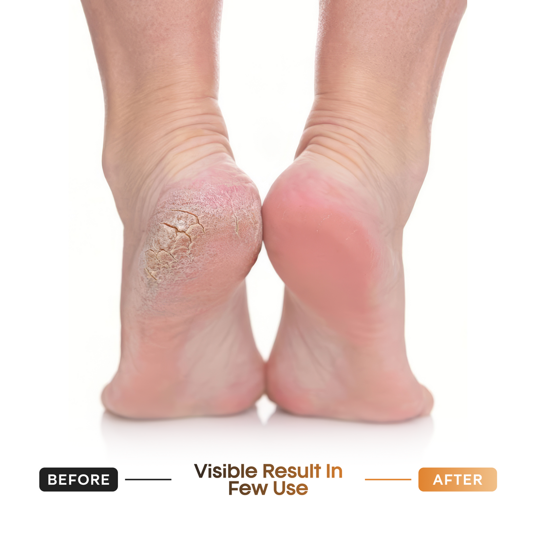 Callus & Dead Skin Removal