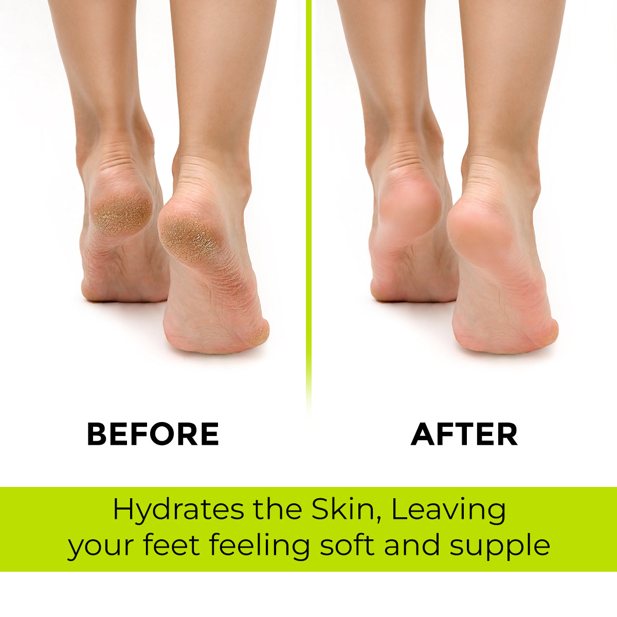 Feet Callus Remover Gel - Effective Callus and Dead Skin Removal